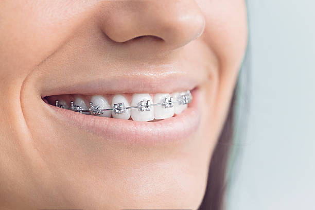 Dental Bonding in St Simons, GA